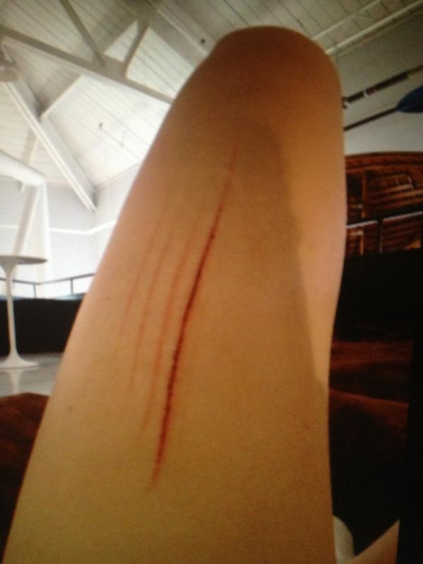 floyd_kate's tweet photo. #StoryBehindMyScar spikes are dangerous #trackproblems http://t.co/Jo9Yt5rx