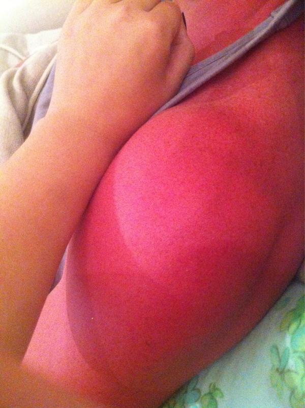 Hugo Johnstone Burt On Twitter Ran Out Of Suncream And Turns Out Spf 15 Moisturizer Just Doesn T Cut It Http T Co Oe88gp7k Twitter