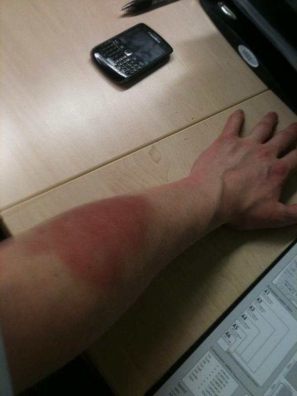 A_BSmith's tweet image. 'let's try kick boxing' = mega bruise from 5ft lady...didn't even see it coming #resolutionFail