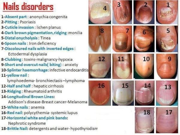 biocarpenter's tweet photo. Well just a common condition of nail diseases. #health #medicine #nutrition #Trivandrum #Kottayam #hygiene #skin http://t.co/9zrfVrZ4