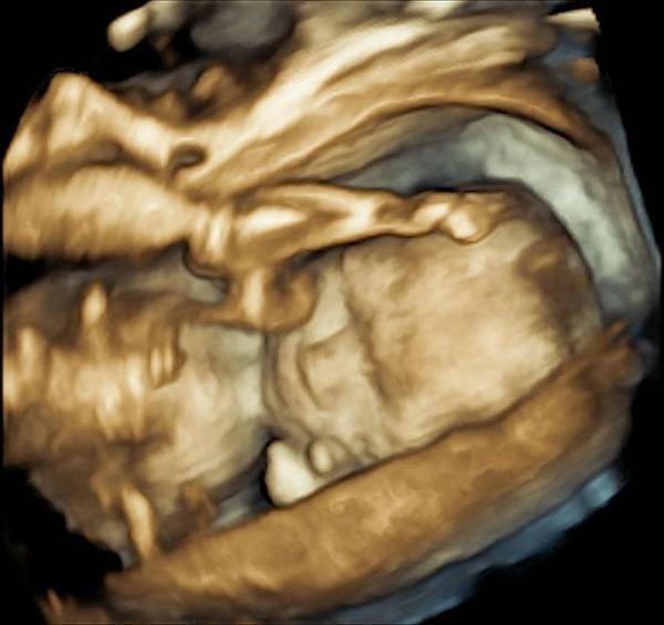 MissyOstrowski's tweet photo. Our sweet Alice Eloise Pearl :) at 20 weeks, I wonder what you look like now! We will meet you soon! @MarkAOstrowski http://t.co/ZSOOYyg7
