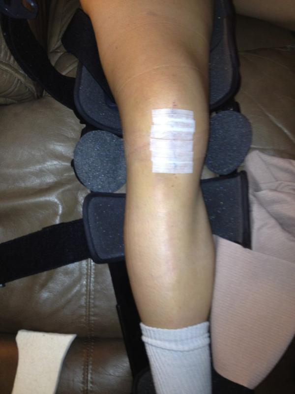 alikrieger's tweet photo. I got my stitches out today!! Making progress :) I'm happy... #recoveryupdates http://t.co/EAOExRax