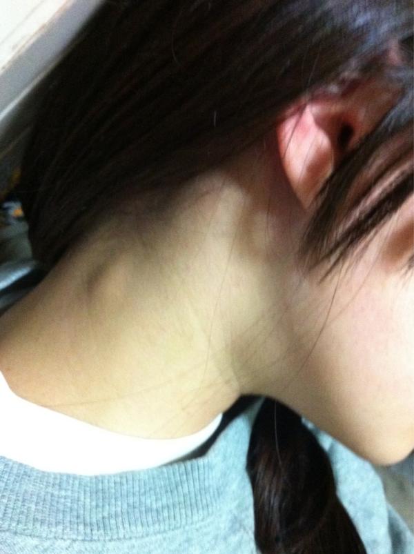 O Xrhsths Msk Sto Twitter 首右後ろのリンパ節こんななう 風邪 治りかけ と肩こりでこんななるか教えてほしいです 恐怖 Http T Co Qgscgre3