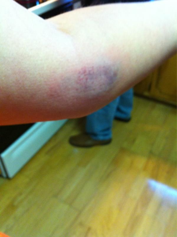 LVmedicchick's tweet image. First time shooting my bow... #ouch #needlessons