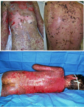 Oj در توییتر トリビア２２ 中毒性表皮壊死剝離症 薬疹は 火傷と同じ 水疱あり 表皮剝離あり 予後は特に悪い 写真閲覧は特に注意 Http T Co Jg615x0s