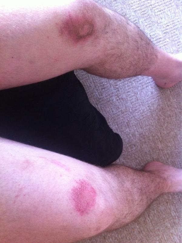 stormingnorm01's tweet image. The negatives of summer rugby #HardGround #SeeYaKneesAndElbows