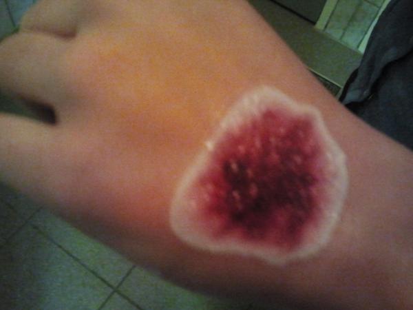 SILKEEEEEx's tweet photo. “@lisaborger_: slechtste neptatoo schaafwond ooit http://t.co/gV9nB7vvkH” omg heftig 2