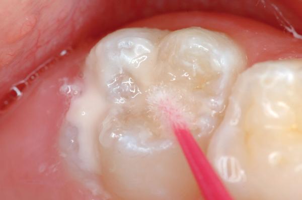 doctorsmilez's tweet photo. Sealents are  effective decay preventive agents done in non operative method in children and adolescents by a dentist. http://t.co/cfnSL4GX