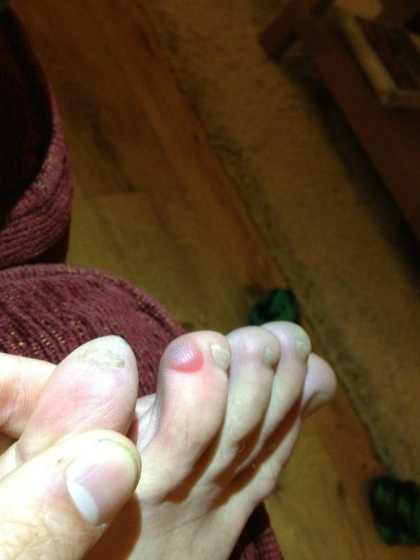 leecummings90's tweet image. Ouch blisters off football #inpain #cannotwalk