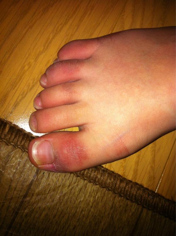 Harabushi もっちゃんの足の親指 黒ずんでたので医者に診せたら しもやけ だそうです 夜中はまだ寒いのに布団掛けないで寝るから Http T Co Jkzrolcc