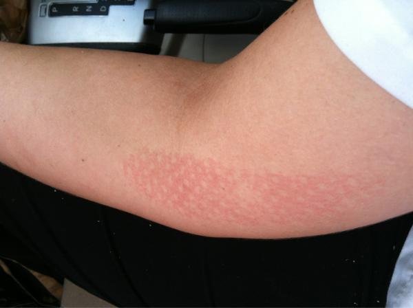 Laurrr_'s tweet image. Nothing like a good burn to wake you up in the morning #bakersproblems #ouch😲🍞