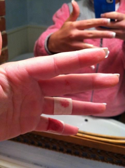 SlurvMeL8r's tweet image. Glass is always an asshole to me #owchie 🚑