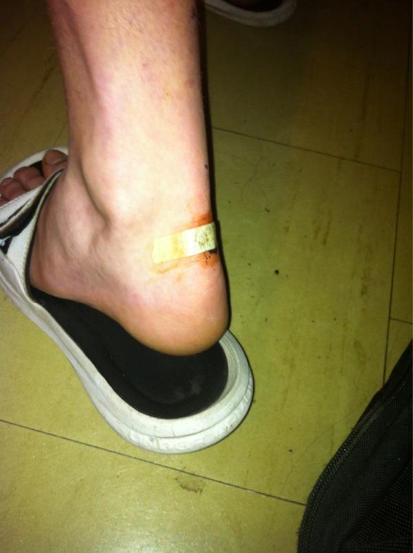 ChewProblemss's tweet image. Chew in the foot #Ouchhh #ChewProblems