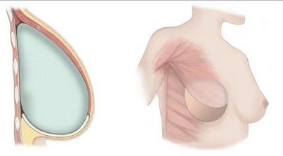 #Risiko Entzündungen bei Brustrekonstruktionen reduzieren j.mp/Je7uGH #selbsthilfe #krebs <a href="/pyramide/">Pyramide France 2</a>