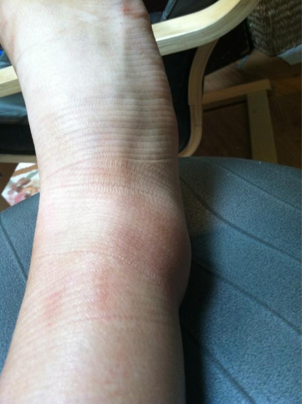 rachel_petes's tweet image. @Throwers_Probz when you sprain your ankle in javelin at the most important part of the season #throwersproblems