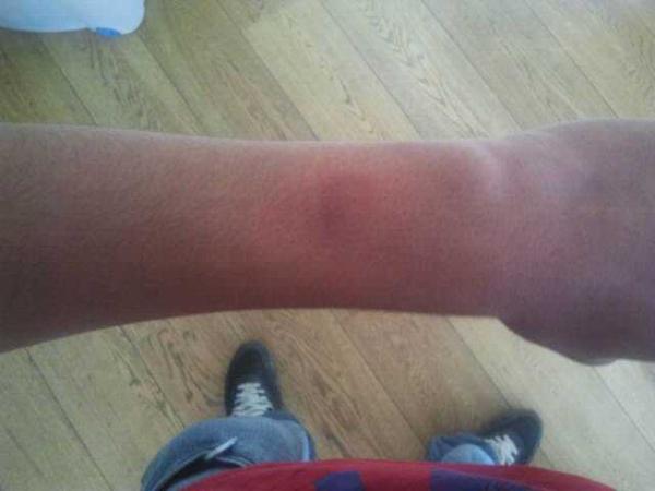 royvanbilsen's tweet photo. me broertje bijt in me arm #au http://t.co/DgyR2PLl