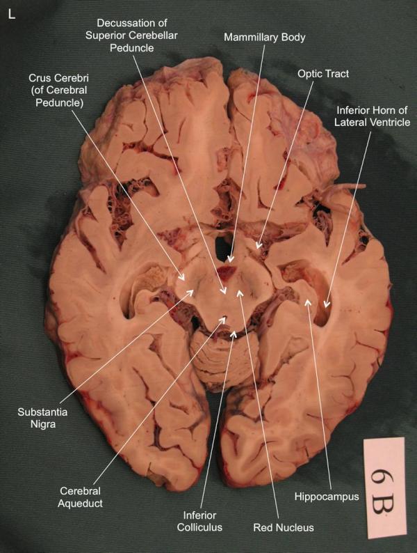 Potongan Coronal dan Horizontal Cerebrum yuk belajar 