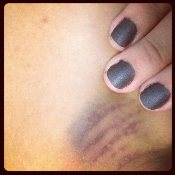 L_Obsession's tweet image. Aww my nail polish @manglaze "cabrón" matches the bruise i have on the back of my knee .. So nice! #nailpolish #bruise