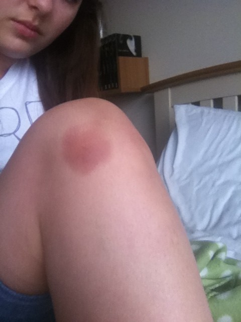 ItsmeAmy96's tweet image. This bruise is making me really depressed, gonna look great in a dress tomorrow and Saturday -.- #sarcasmexplosion