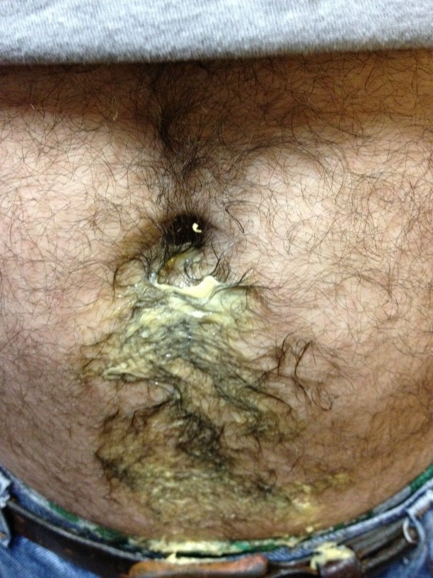 AuW8aQtCIAAj cZ - How To Remove Hair From A Photo Dad's Garage Theatre on Twitter "It's not a pilonidal