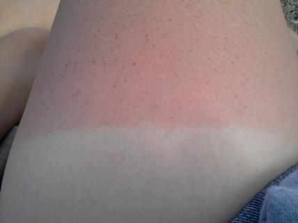 payrey15's tweet image. Imma lil burnt.. #owchie
