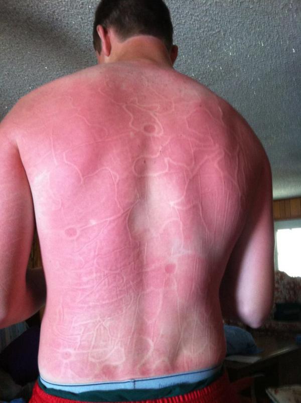 Attithehun's tweet image. only i can walk around on the beach and then decide to take a nap on the couch the morning after...#ouch #humanmap