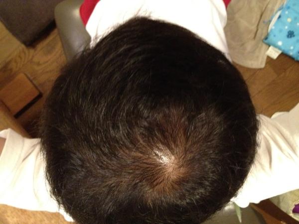 DLIFE1's tweet photo. ６月６日
量は増えた。
でもまだ地肌がよく見えますな。
こんなもんなのかな。 http://t.co/iqFzW8Gh