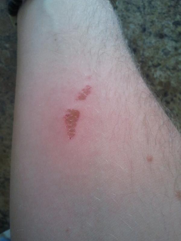 WheresWallyy's tweet image. Bruising gone down, scab appearing @BaynhamJames #armupdate