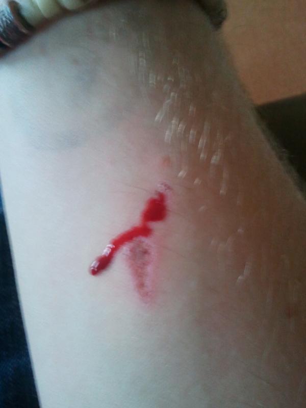 WheresWallyy's tweet image. @BaynhamJames 5 days later we get blood #armupdate