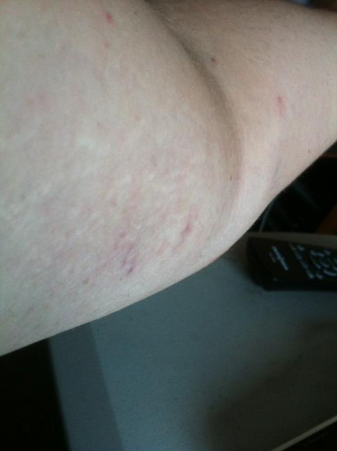 emmesue's tweet image. My battle scar from archery. I keep poking the bruise.