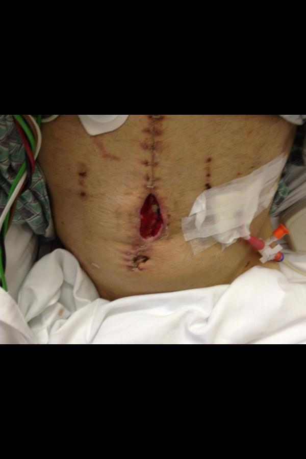 HugoBraham's tweet photo. The wound my squeamish friend, Lisa, changed. http://t.co/yPFGVjVQ