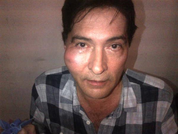 Recuerda que Jean Carlo Simancas sufrió un accidente y recibió una patada de un caballo en la cara, aquí la foto.