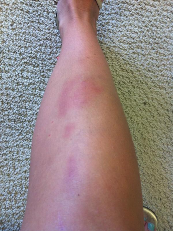 emkgibbs's tweet photo. If someone could let me know how I got these bruises last night, I'd really appreciate it #what #ow http://t.co/QxLA1VaD