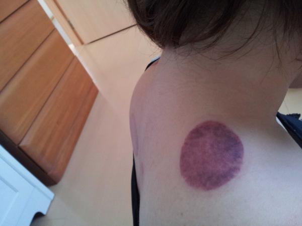 Chinatsu En Twitter 肩こりがひどいのでお友達にカッピング 吸い玉 をやってもらったらかなり血流が悪いみたいで痕が凄いことに ロ でも背中がポカポカで血流が良くなったみたい V Http T Co Mo0tm7gu