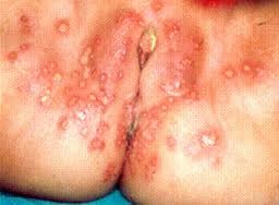 fantashcamp's tweet photo. @EdinCraig #Vaginalherpes http://t.co/w1HbxT3P