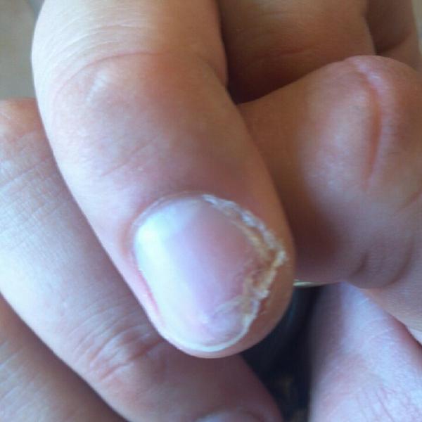 stlmortgagenerd's tweet image. Broken nail! #pitcherproblems #manicuresarentjustforwomen!