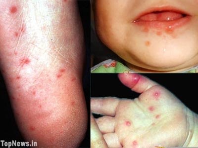 PedsBoards's tweet photo. Hand-foot-and-mouth disease common cause of mouth sores in pediatric patients Cause coxsackievirus A16 #usmle #FOAMed http://t.co/3wLSa00LRs