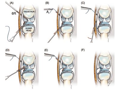 Artículo:A Technique for Arthroscopic All-inside Suturing in the Wrist #cirugía #mano #artroscopia es.scribd.com/doc/100189029/…