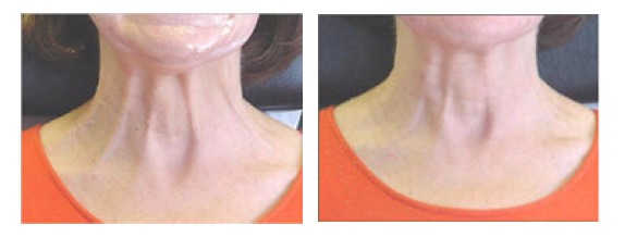 Гипертонус платизма ботокс. Ботокс на ще. Платизма ботокс до и после. Ботулинотерапия платизмы. Ботулинотерапия нефертити.