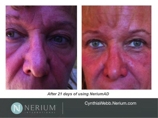 realNerium's tweet photo. #NeriumAD is amazing -- look at Cynthia's lips in this photo. Try NeriumAD w/30-Day Guarantee! http://t.co/L1now8th http://t.co/gXVF9PMT