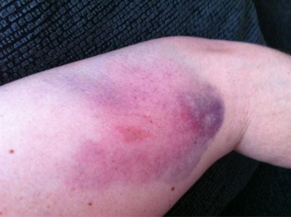 Laceyk85's tweet image. Classic 'falling down the stairs' arm injury #epicfall