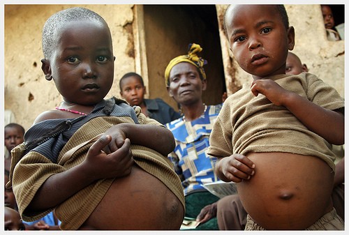 محمد الكربي على تويتر هل تعلم أن انتفاخ البطن لدى الأطفال الفقراء في أفريقيا سببه مرض يسمى كواشيوركر ينتج عن نقص البروتين الحاد في طعامهم Http T Co Seojdq7e
