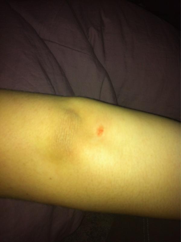 mary_rebecca13's tweet image. thanks Andrew 😢 #owchie #itburns