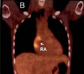 CircAHA's tweet photo. A 44 year-old woman with Listeria endocarditis and right atrial mass. How would you treat? http://t.co/fb3MNhv8 http://t.co/gCQFmBCB