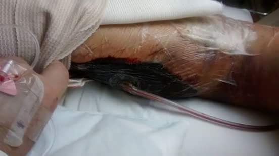 MehaffeyRoberta's tweet photo. Adam Caudill my daughter Elizabeth Caudill husband were just thankful they saved his arm Thank God. http://t.co/h7urZve93x