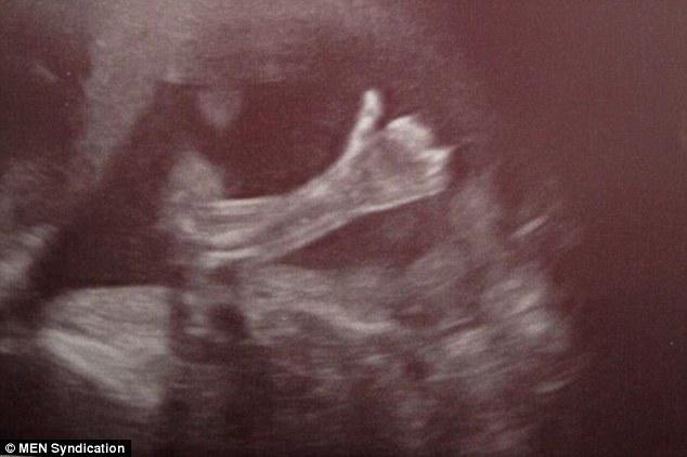 A3Noticias's tweet photo. El emocionante momento en que un bebé levanta el pulgar a sus padres en una ecografía http://t.co/Q56E5rkqki http://t.co/WOzLO9vSku
