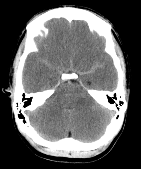 Q: TRUE or FALSE: subarachnoid haemorrhage is present. ANSWER: goo.gl/GFWDqJ #FOAMrad #FOAMed