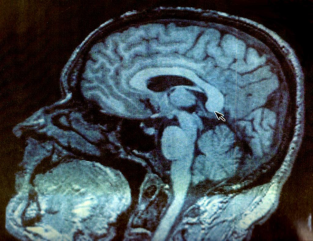 Bob McKenzie (@tsnbobmckenzie) on Twitter photo “<a href="/SportsCentre/">SportsCentre</a>: <a href="/rwesthead/">Rick Westhead</a>: May be possible to diagnose CTE in living patients. tsn.ca/1.210725 ” great read. “<a href="/SportsCentre/">SportsCentre</a>: <a href="/rwesthead/">Rick Westhead</a>: May be possible to diagnose CTE in living patients. tsn.ca/1.210725 ” great read.