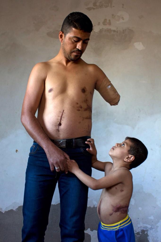 Lost limbs and shattered lives: the British doctors on the frontline in Gaza  B-OdxbIIAAASJ-5