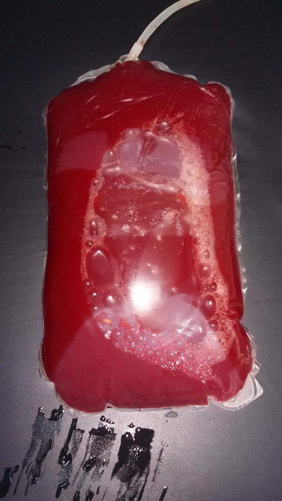 LuiggiCL's tweet photo. @dialisisperitoneal @Nefrologia... Hemoperitoneo http://t.co/o4s3utFsSU